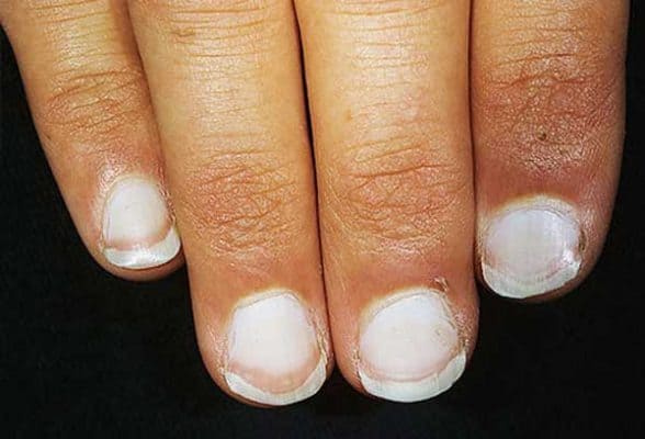 Nails That Tell Health Condition - Nails Indicate diseases